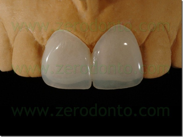 42 veneers provvisorie