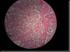 adeno CA  high resolution histology slide tsnaps