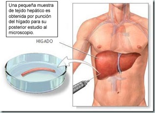 Biopsia Higado Graso