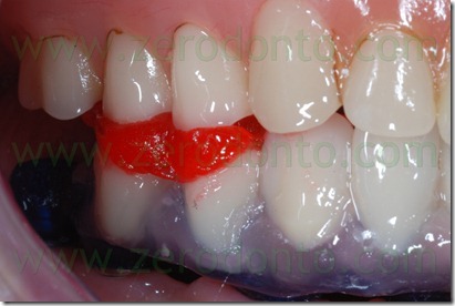 pattern resin