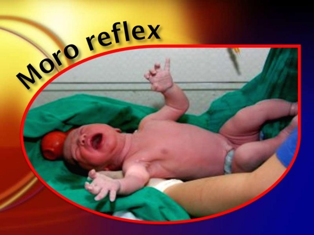 [moro%2520reflex%2520medicalshow%255B2%255D.jpg]