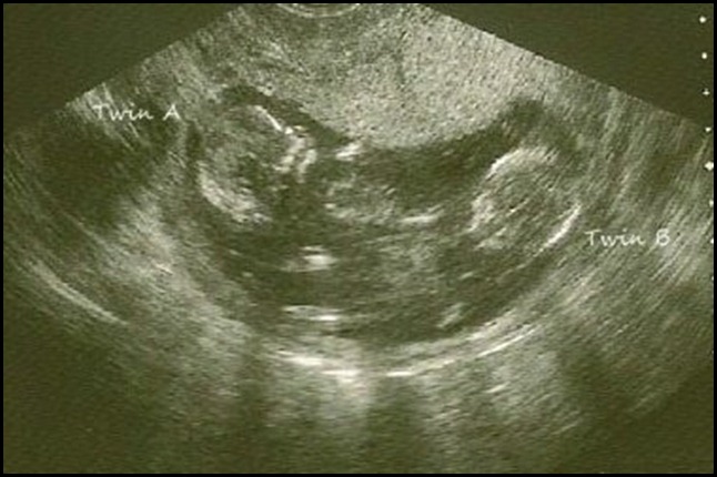 twin ultrasound