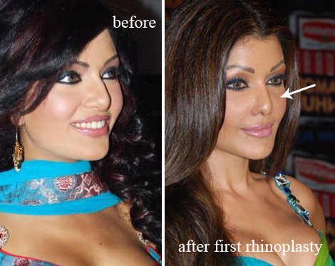 [koena_mitra_before_and_after_nose_job%255B3%255D.jpg]