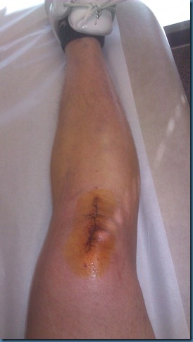 acl_post_stiches_out