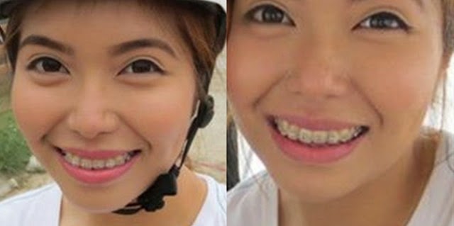 old braces old braces