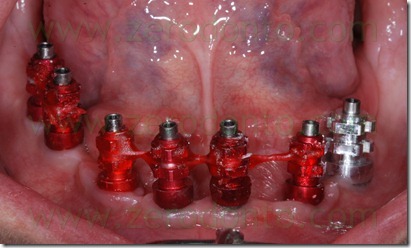 impronta su impianti coping transfer splintati