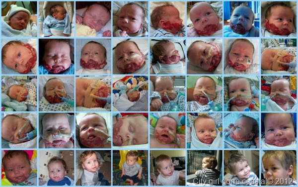 birthmark in pictures