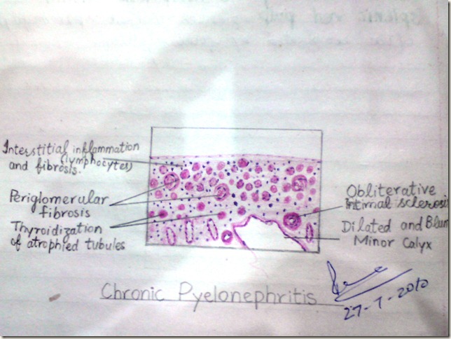 chronic pyelonephritis diagram histopathology
