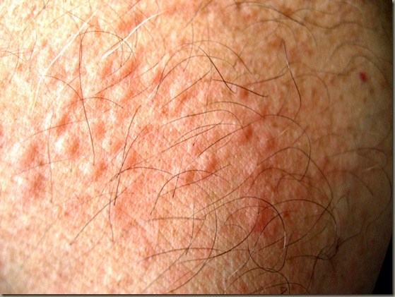 Horrid Rash Horrid Rash