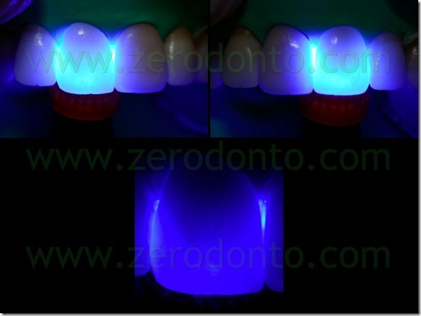 118 transilluminazione luce alogena faccette