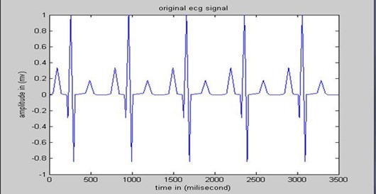 After removing noise from ECG signal