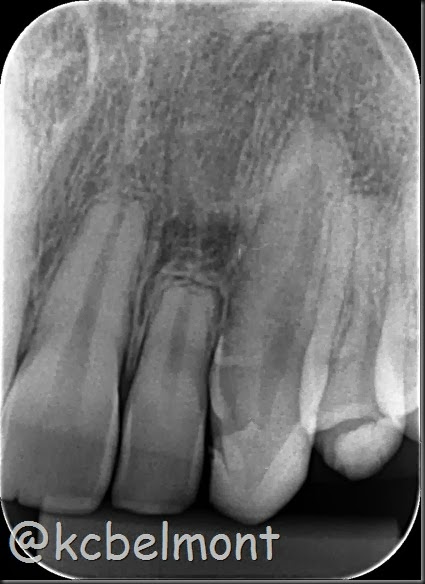 reabsorção radicular periapical 22 reabsorção radicular periapical 22