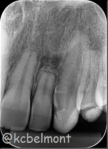 reabsorção radicular periapical 22