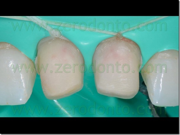 110 digia di gomma veneers