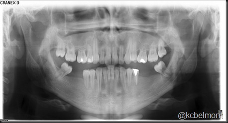 reabsorção radicular externa generalizada reabsorção radicular externa generalizada