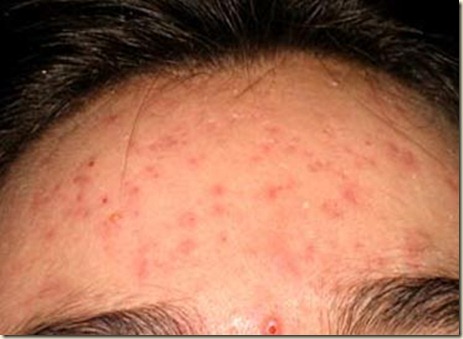 acne-NTNVa