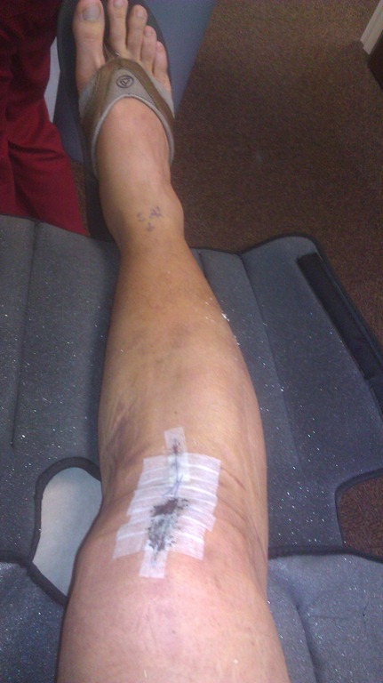 [acl_post_op_tape%255B2%255D.jpg]