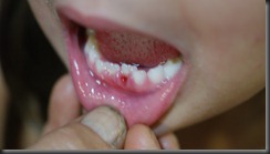 kiera tooth 006