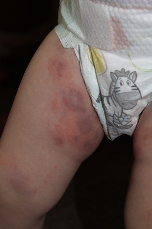 [2012-02-09%2520Hives%252C%2520Day%25203%2520-%25207%255B4%255D.jpg]