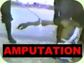 Islamic Amputations..البتر فى الإسلام