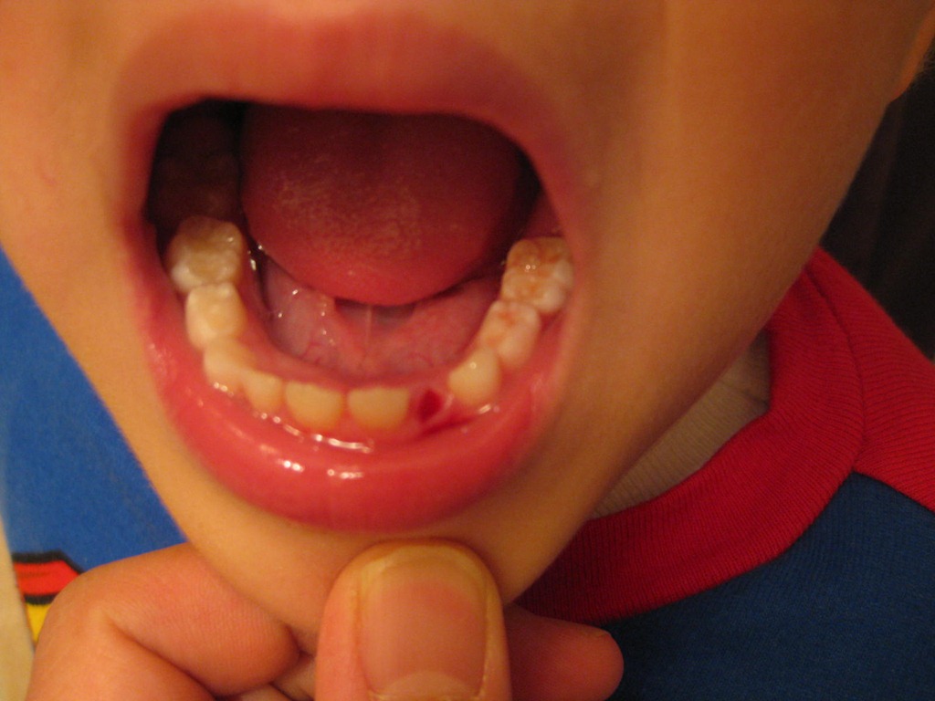 [missing_tooth1%255B3%255D.jpg]
