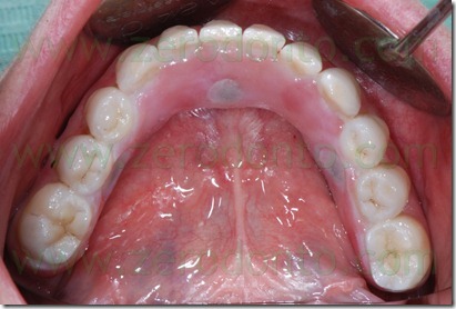 zirconia bridge