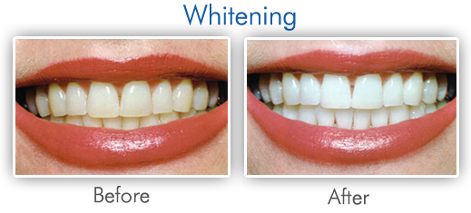 [teeth_whitening%255B3%255D.png]