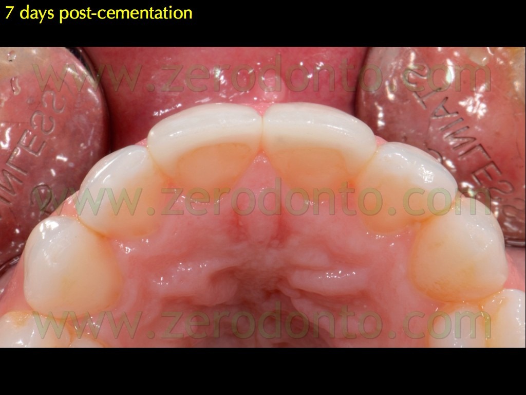[131-occlusione-faccette-chamfer-pala%255B2%255D.jpg]
