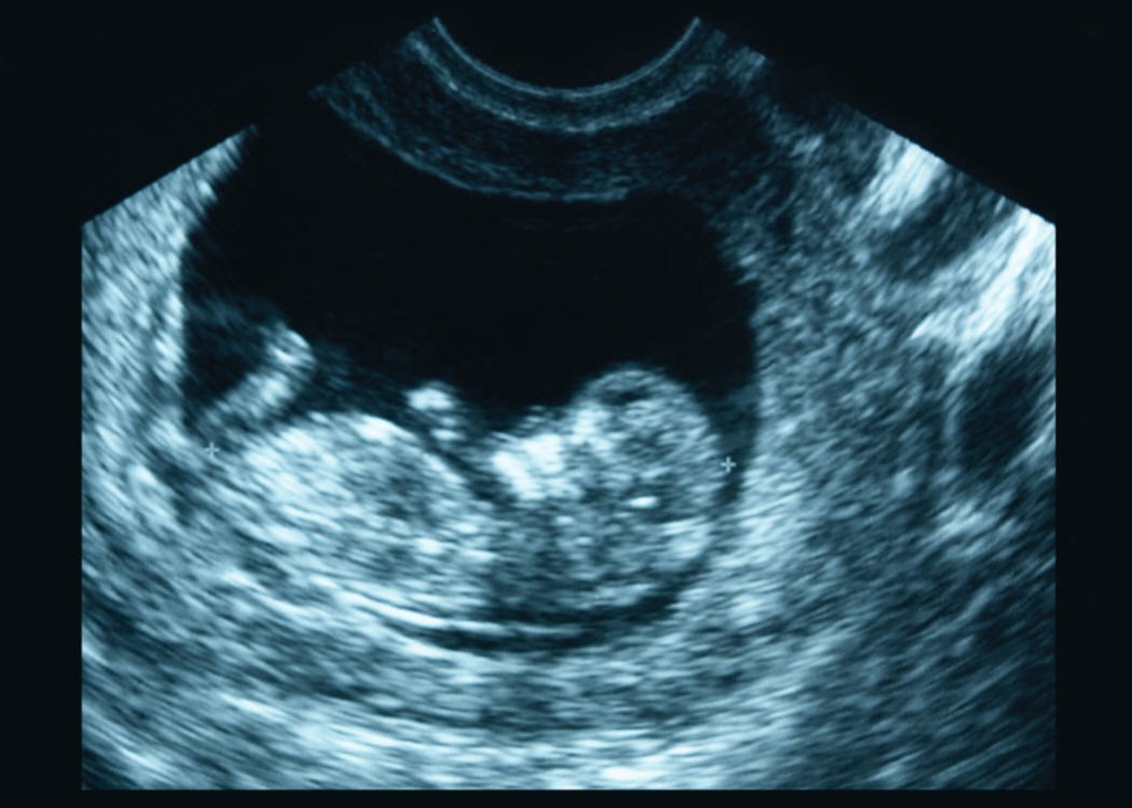 [ultrasound%255B13%255D.jpg]