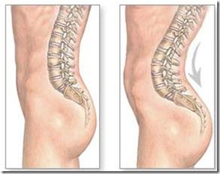 Lordosis