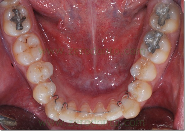 21 allineamento denti