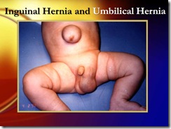 inguinal hernia umbilical hernia medicalshow