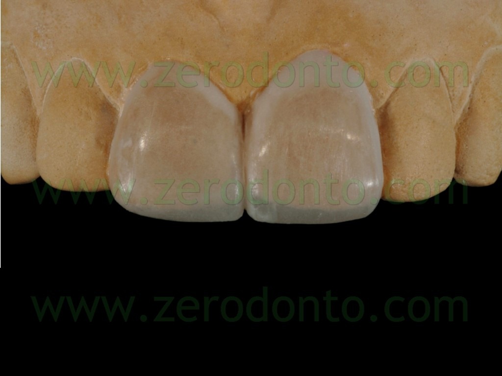 [37-faccette-wax-up-additivo4.jpg]
