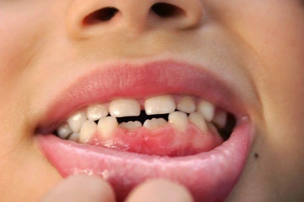 Order Doxycycline Teeth