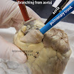 pulmonary_trunk_labeled.JPG