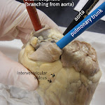 pulmonary_trunk_labeled.JPG