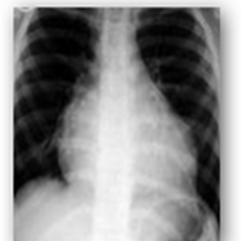 Breath Test May One Day Identify TB and Other Lung Diseases As Strains of Bacteria Have Been Identified With Testing the Breath Exhaled With Lab Mice