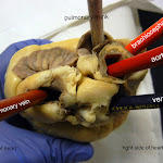 heart_pulmonary_vein_labeled.JPG