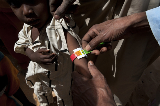 An MSF staff member measures the mid-upper arm circumference (MUAC) of a child with severe acute malnutrition in Chad. Chad 2011 &copy; Alfons Rodriguez