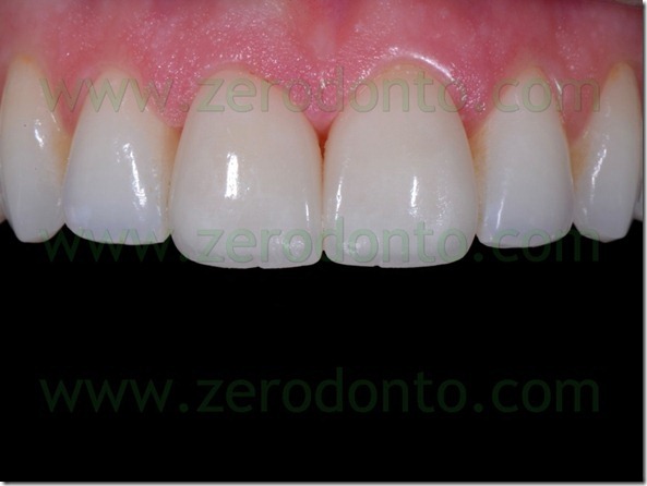 123 cementazione estetica faccette ceramica