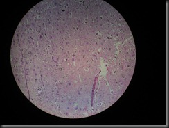 giant cell tumor high resolution histology slide tsnaps