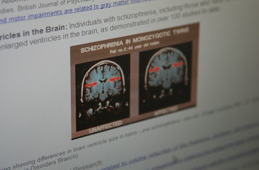 These images show how the ventricles of a person with Schizophrenia are enlarged. (Photo credit: Alex Crowder)