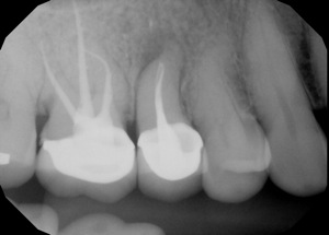 Endo retx1.jpg