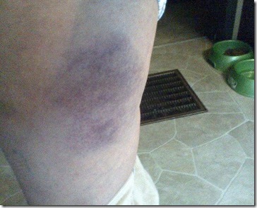 bruise day 3 bruise day 3