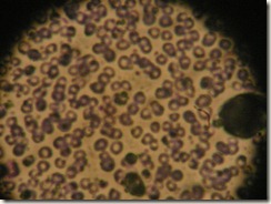 microcytic anemia hematology slide