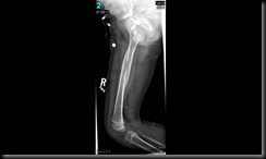 Broken femur healing 7-8-2011 (2)