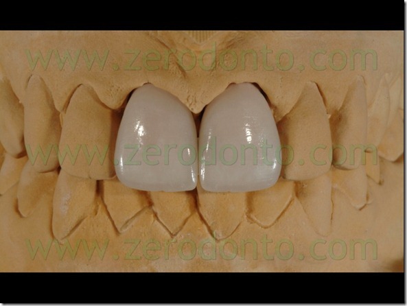 91 stratificazione ceramica glasura faccette