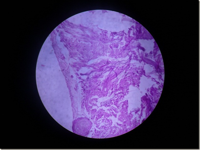 squamous cell carcinoma histopathology