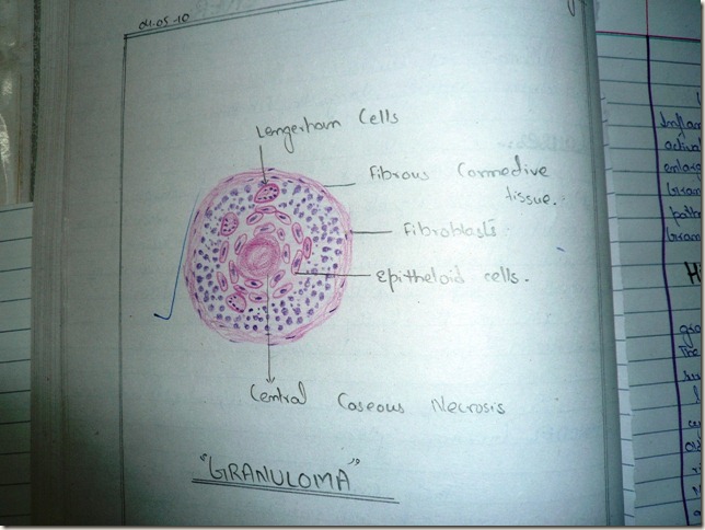granuloma in tuberculous lymph node diagram histopthology