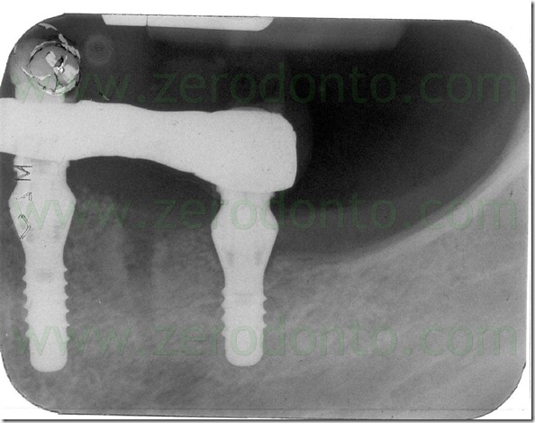 - (212) adattamento passivo protesi - (212) adattamento passivo protesi
